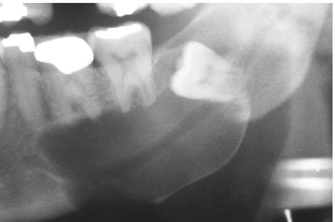 Dentigerous Cyst.