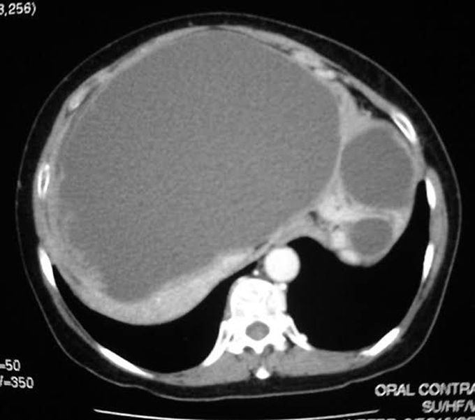 Hydatid liver disease