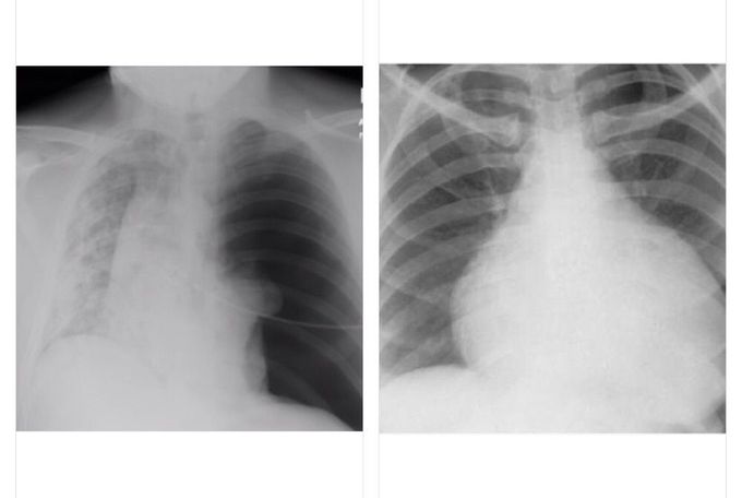 TENSION PNEUMOTHORAX VS CARDIAC TAMPONADE.