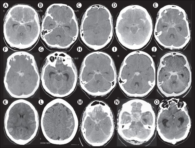 Signs And Symptoms Of Subarachnoid Hemorrhage Medizzy