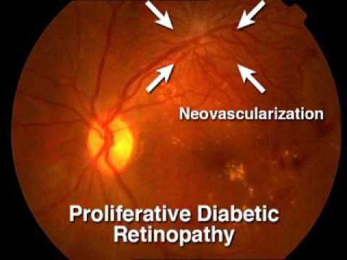 Examination of the Retina (Fundoscopy)