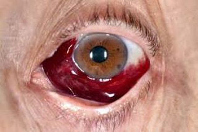 Subconjunctival hemorrhage