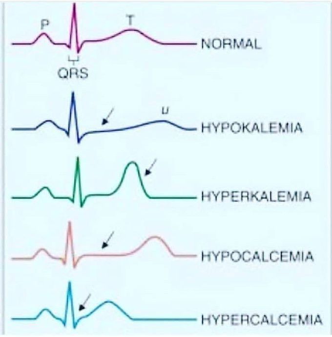 ECG change in different electrolyte anomalies