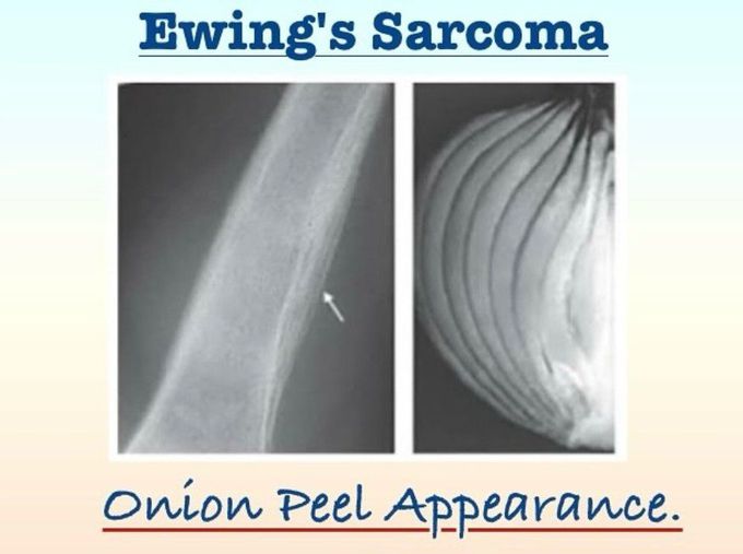 Ewing Sarcoma