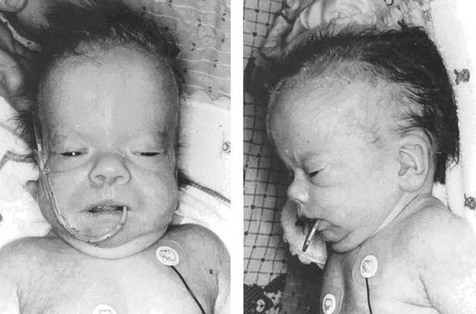 Schinzel Giedion syndrome (SGS)