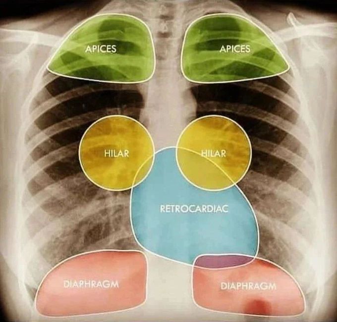 Hidden Areas in CXR