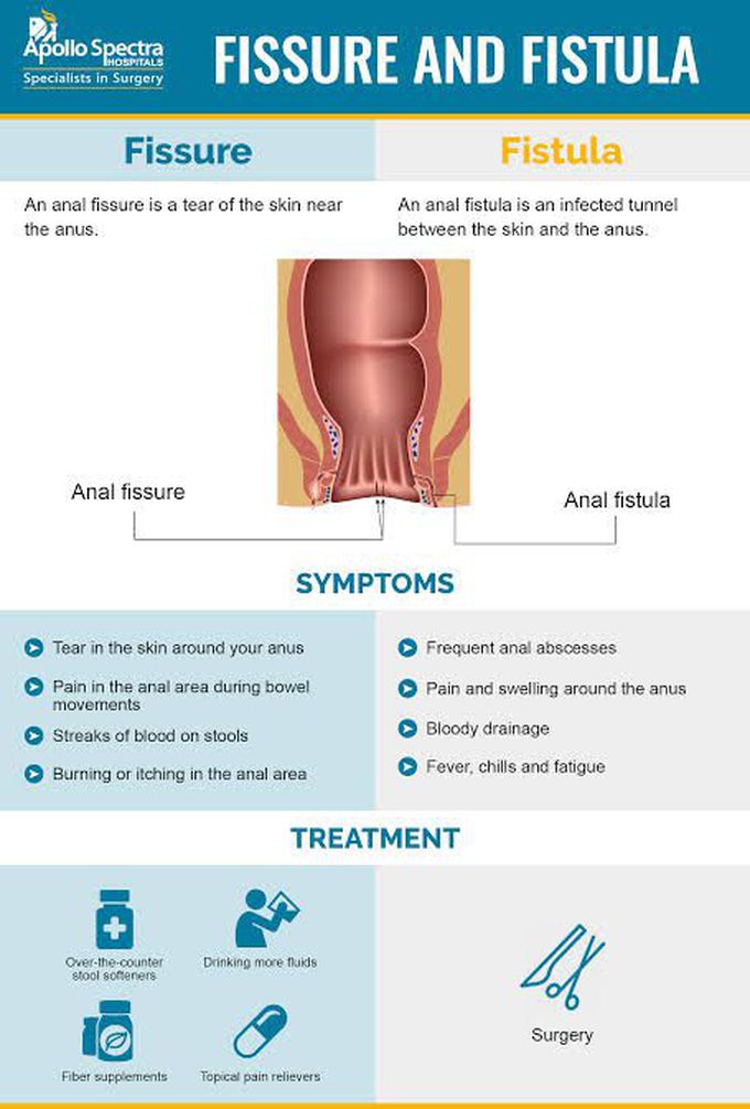 Fissure and Fistula