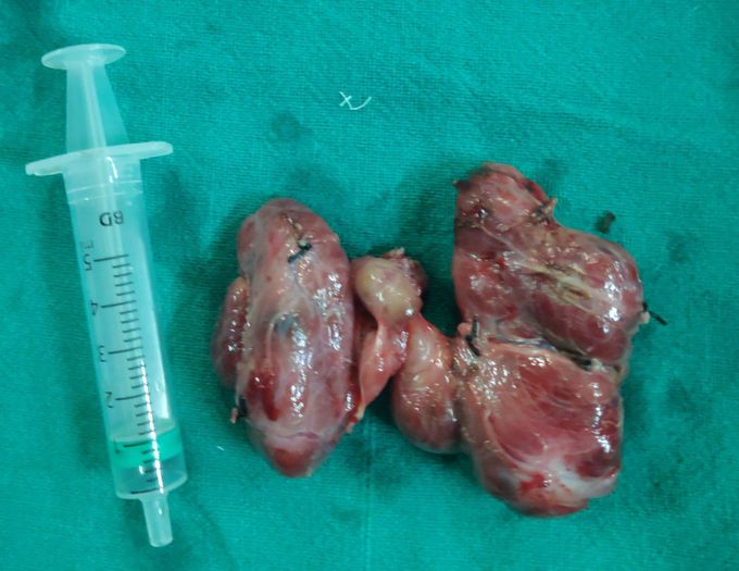 Colloid Multinodular Thyroid