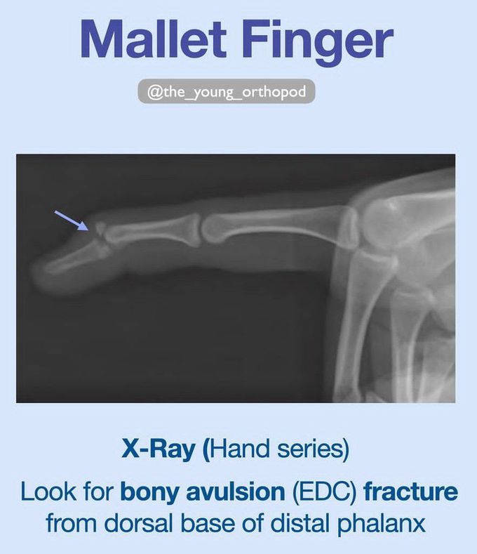 Mallet Finger III