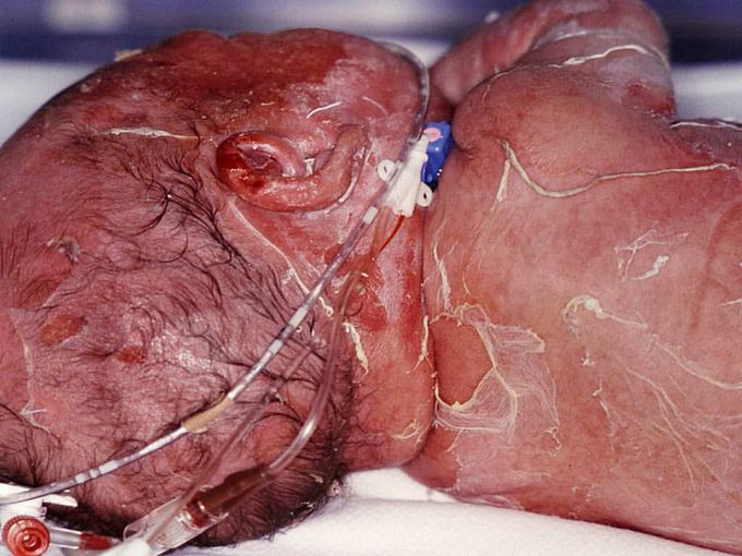 Newborns’ skin is all shedding due to an infection!  