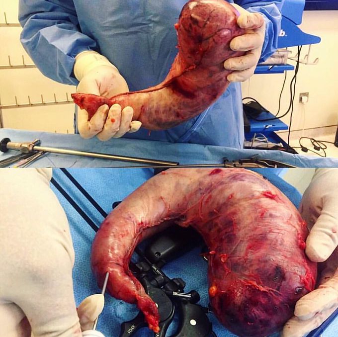 Gastric sleeve