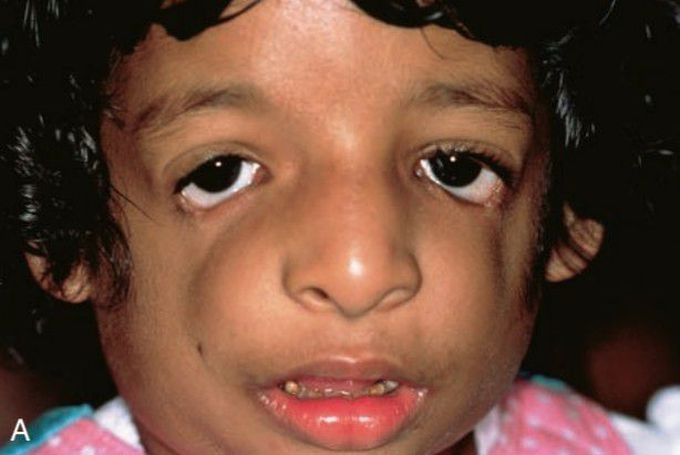 Treacher collins syndrome