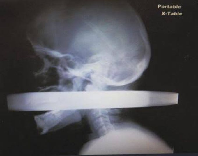 This X-ray shows 28-year-old Las Vegas man Andrew Linn, who survived a 2010 car accident that pushed a 2-inch-thick metal fence pole through his mouth and out through the back of his neck, according to a report of his case in the Las Vegas Review-Journal.

Linn "was very calm and didn't appear in any pain," surgeon Dr. Jay Coates, of University Medical Center, told the Review-Journal. The medical team at was able to remove the pole without damaging either of two major blood vessels — the carotid artery and jugular vein — in the neck region.