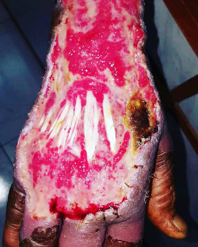 Severe Upper Limb Trauma