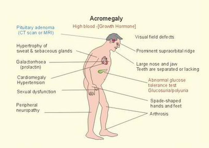 Acromegaly
