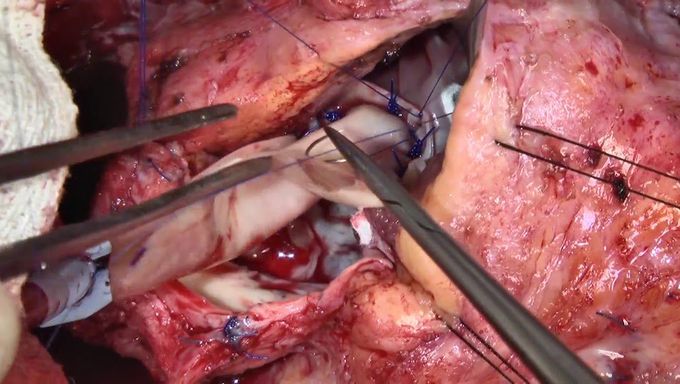 Konno Aortoventriculoplasty and Mitral Valve Replacement in a Child With AV Septal Defect