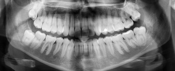 This New Treatment Could Heal Tooth Cavities Without Any Fillings