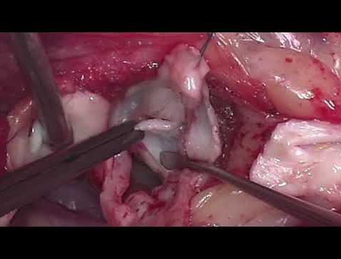 Ross-Konno Procedure