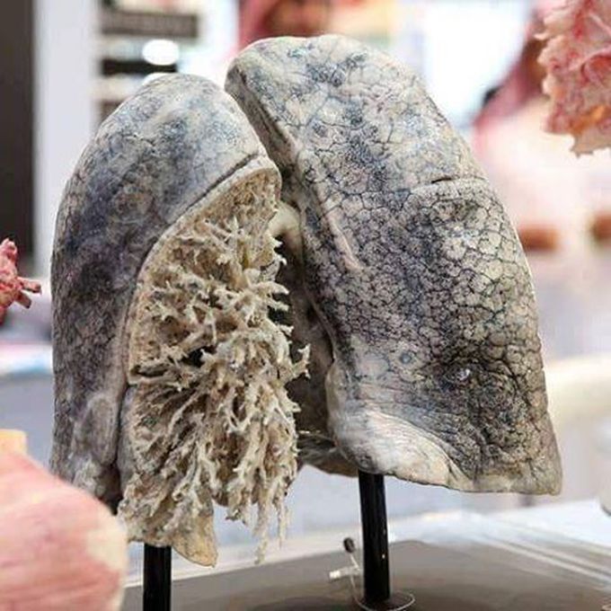 Lung Cancer