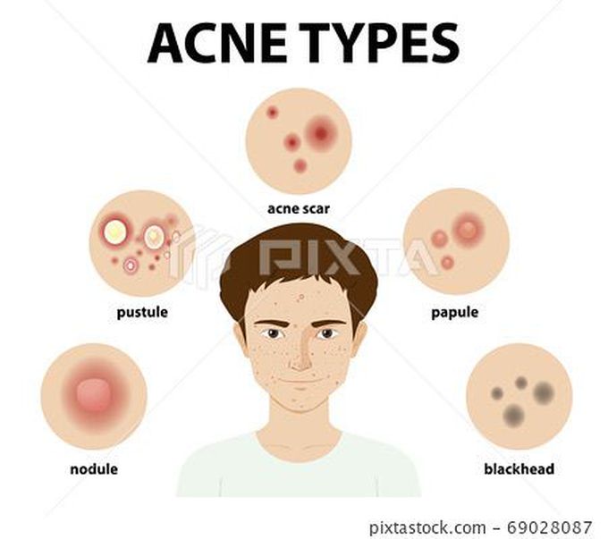 Acne types 🌹