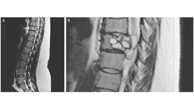 A Woman Had Strange Feelings in Her Legs. Doctors Found Parasites in Her Spine