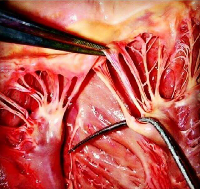 Papillary muscle of 💗
