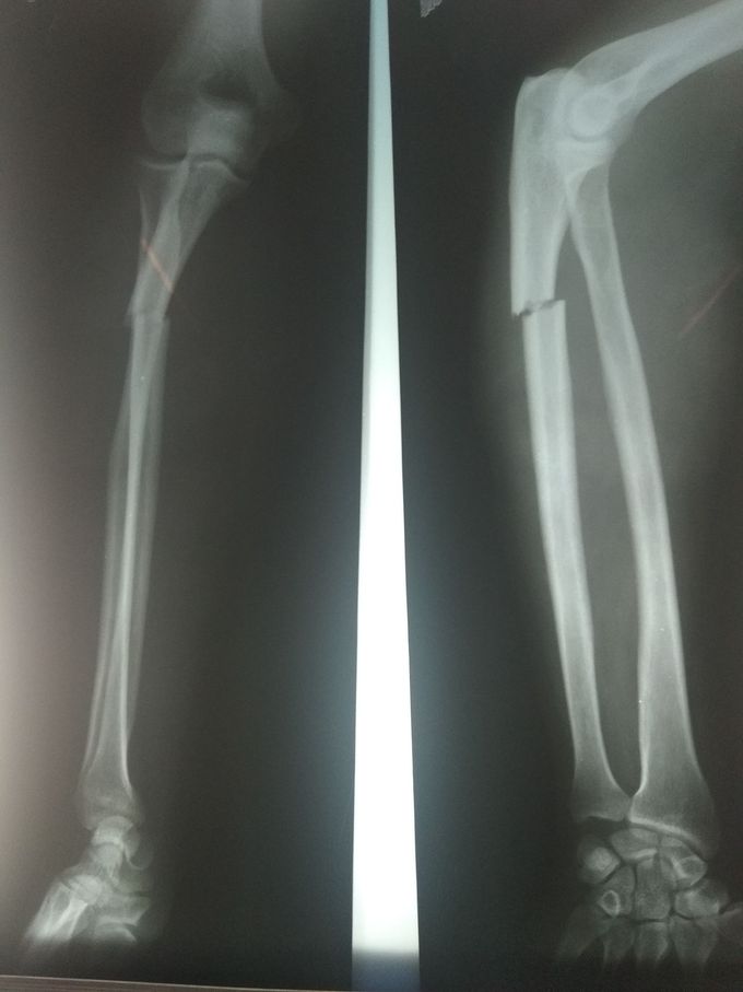 Ulna fracture