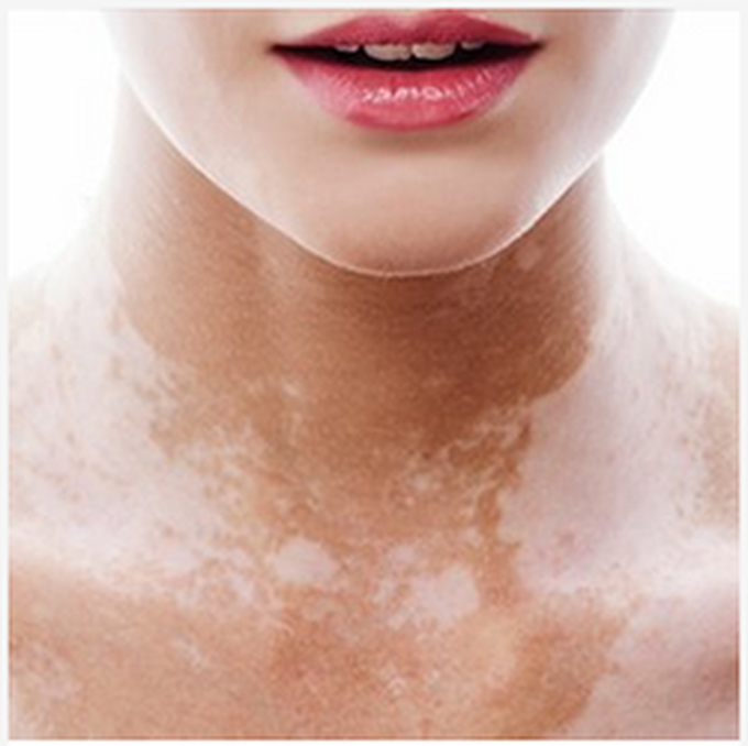 Vitiligo