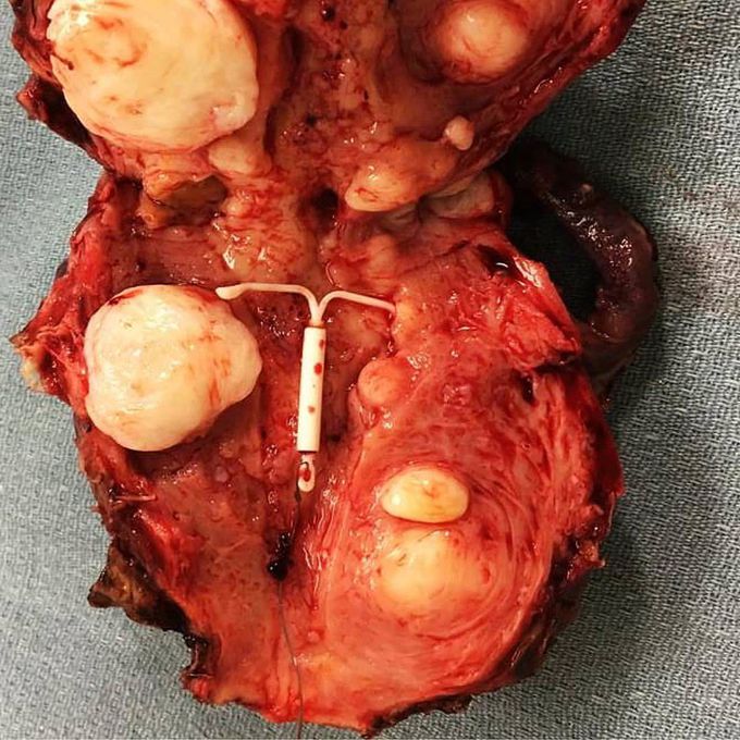 Multiple uterine myomas of different sizes! Who knows what’s the device at the center? 