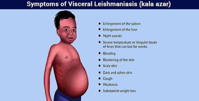 Visceral leishmaniasis