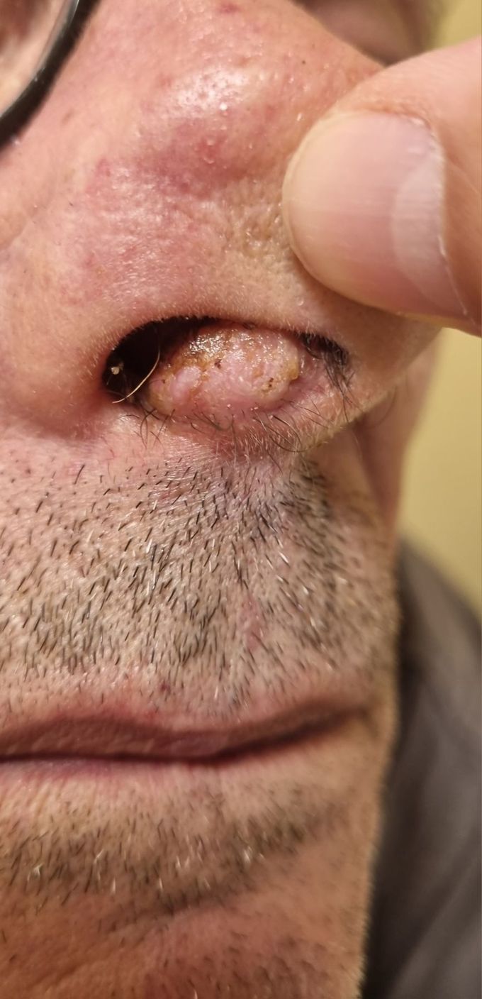 Slowly enlarging nasal vestibule lesion