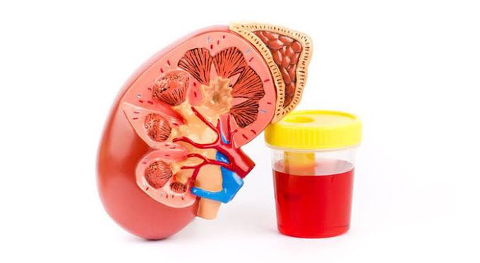 Causes of hematuria