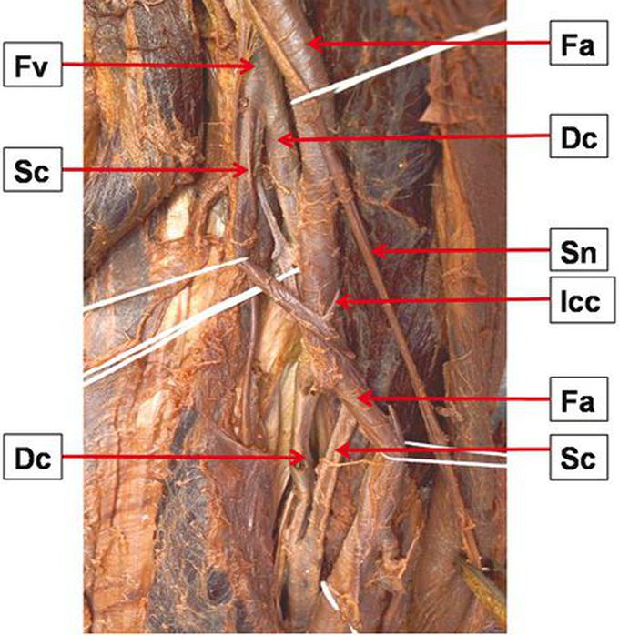 Photograph of the femoral triangle showing duplicated femoral vein (Fv); Fa — femoral artery; Sn — saphenous nerve; Dc — deep component; Sc — superficial component; Icc — interconnecting channel.