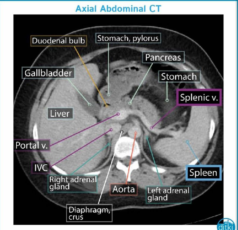 An Axial Slice Of A Ct Scan With Labeled Anatomical 1080x1069