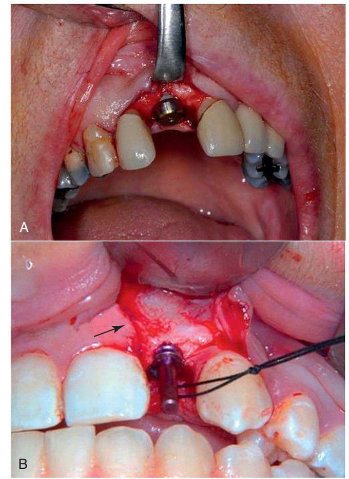 Implant placement