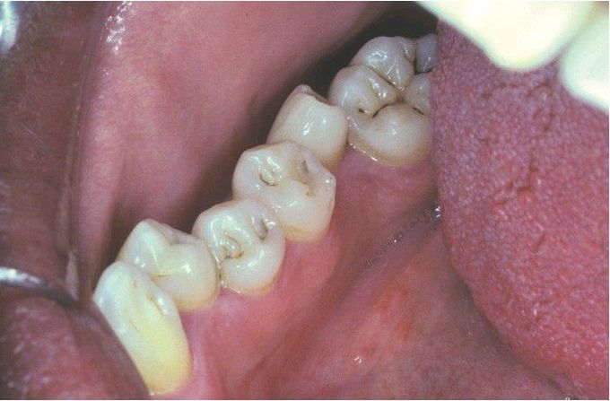 Hyperdontia