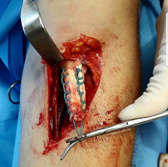 Surgical repair of a ruptured distal biceps tendon while lifting!! 