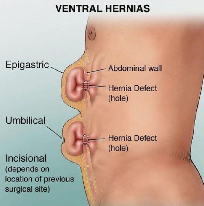 Ventral hernias