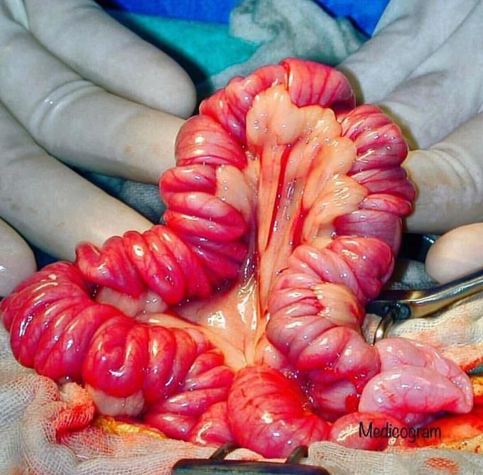 Picture depicting small intestine and the mesentery: 