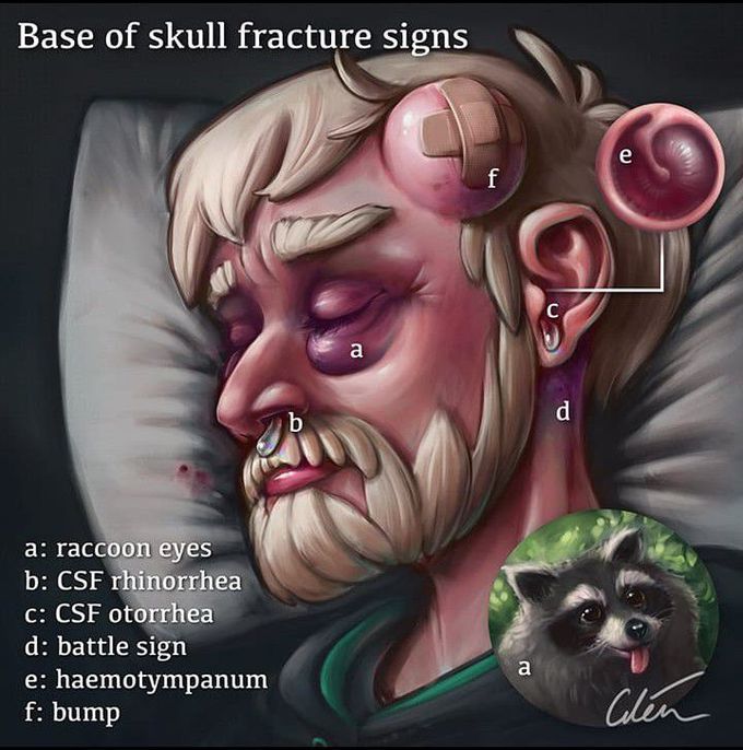 Skull base fructure signs