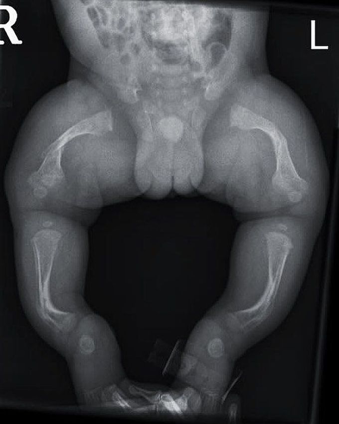 Osteogenesis imperfecta