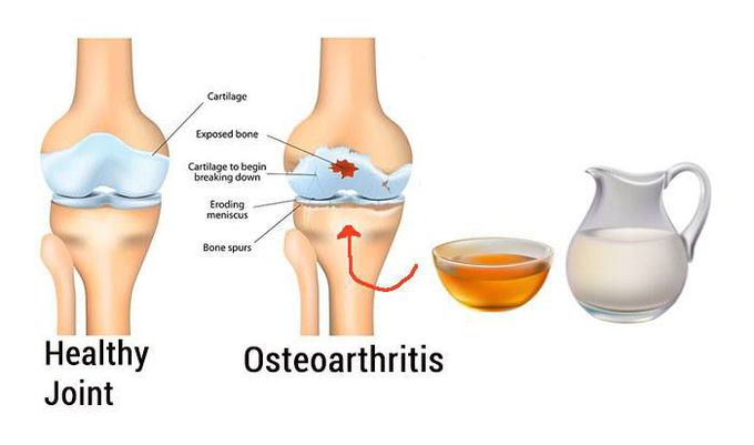 OSTEOARTHRTIS