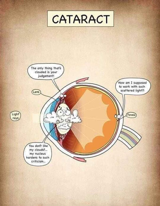 Cataract