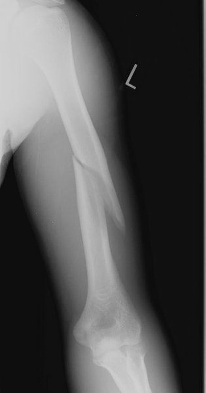 Radiograph of left arm demonstrates a spiral midshaft humeral fracture