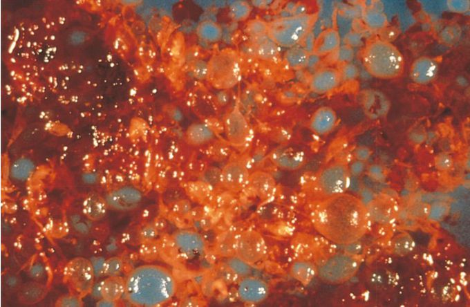 Female reproductive disorder