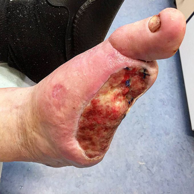 A diabetic foot with toe amputation that lead to ulceration