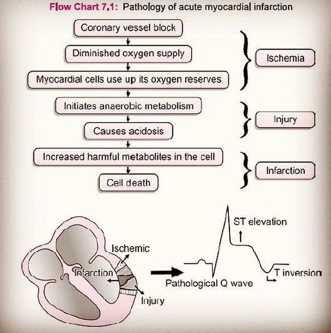 Myocardial infarction