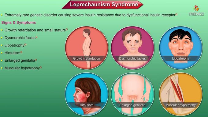 Leprechaunism / Donohue syndrome