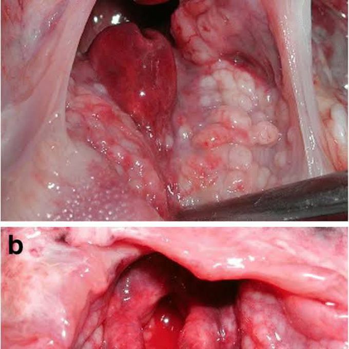 Acute epiglotittis