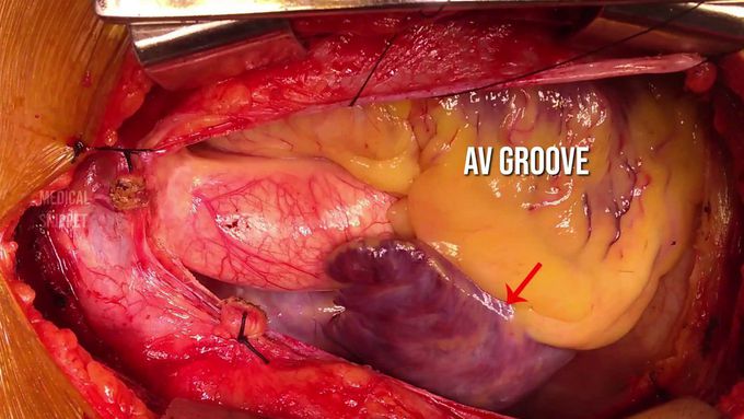External Anatomy of Heart for real